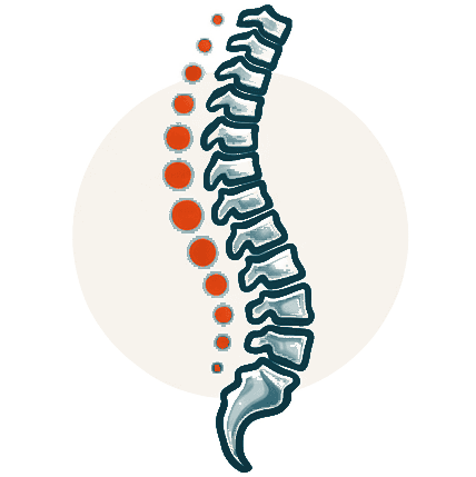 Scoliosis